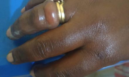 Woman Almost Lost Finger After Wearing Wedding Ring Bought From Her Friend