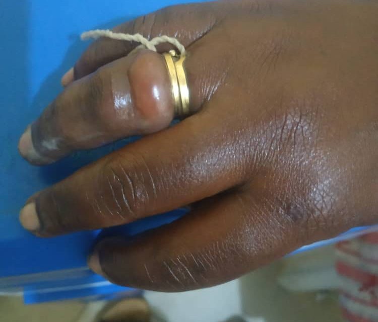 Woman Almost Lost Finger After Wearing Wedding Ring Bought From Her Friend<span class="wtr-time-wrap after-title"><span class="wtr-time-number">1</span> min read</span>