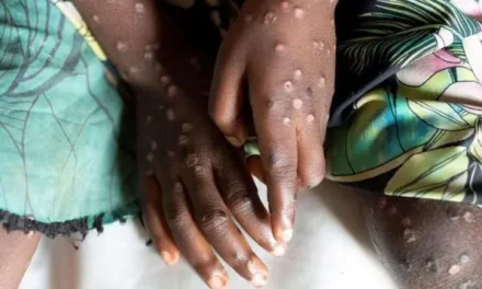 Mpox Not New Covid And Can Be Stopped, Expert Says