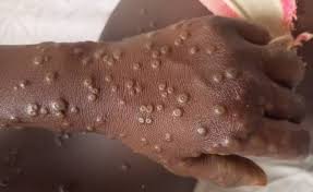 GHS to Implement Mpox Screening for Incoming Travelers