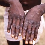 Ghana Records First Mpox Case, 230 Suspected Cases Under Investigation