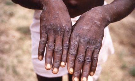 Ghana Records First Mpox Case, 230 Suspected Cases Under Investigation